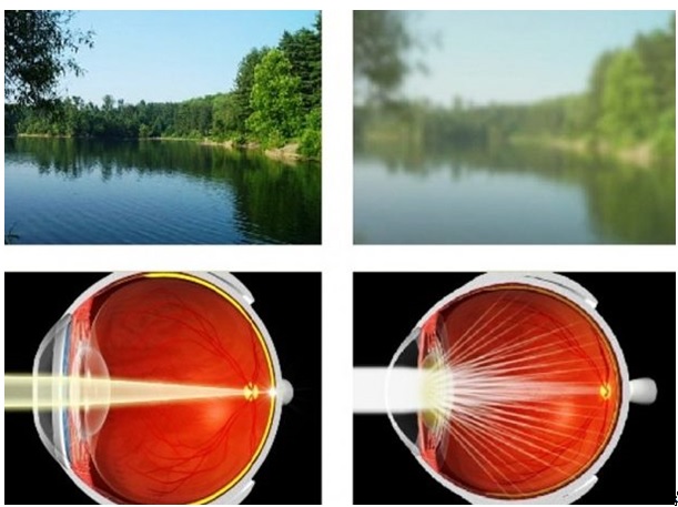 a látás javulása 50 év után a látás egy dioptriával esett